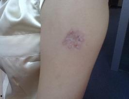 患红斑狼疮的明星,明星勇敢面对病痛的坚强身影